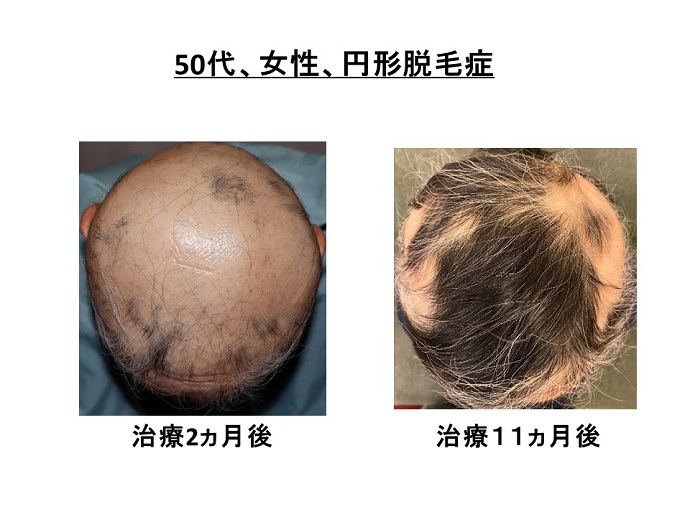 円形脱毛症　病院